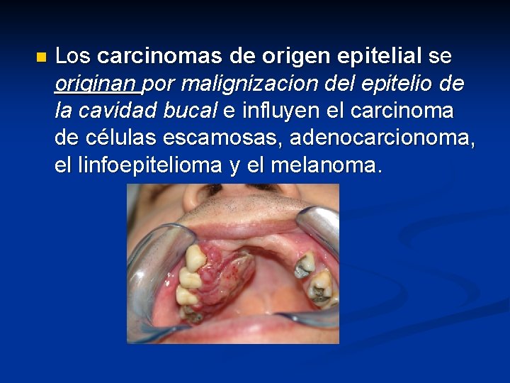 n Los carcinomas de origen epitelial se originan por malignizacion del epitelio de la