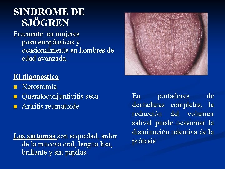 SINDROME DE SJÖGREN Frecuente en mujeres posmenopáusicas y ocasionalmente en hombres de edad avanzada.
