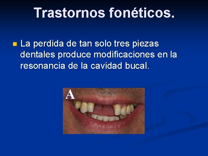 Trastornos fonéticos. n La perdida de tan solo tres piezas dentales produce modificaciones en