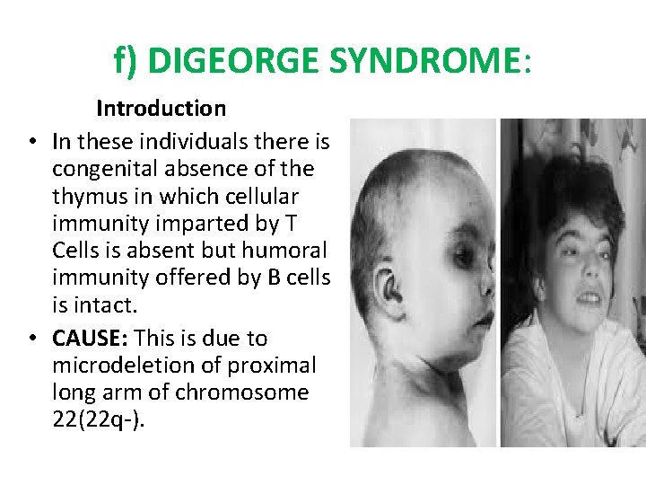 f) DIGEORGE SYNDROME: Introduction • In these individuals there is congenital absence of the