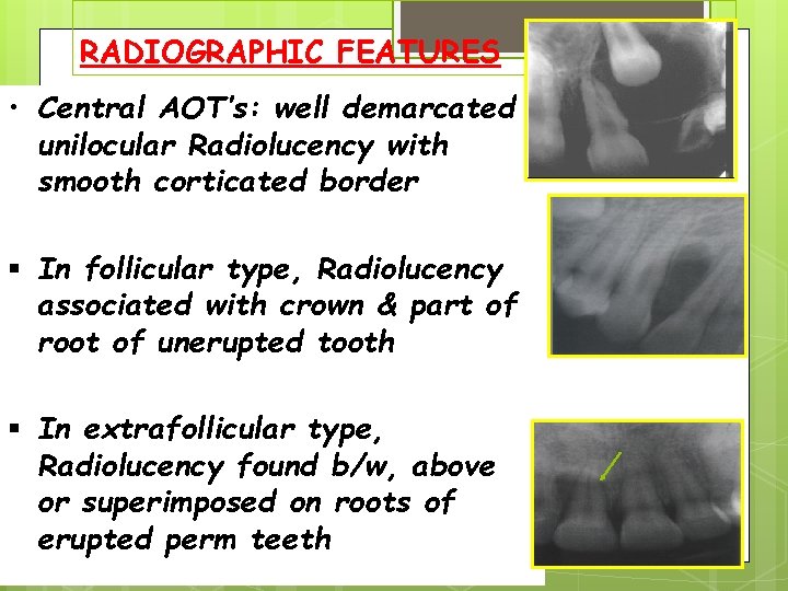 RADIOGRAPHIC FEATURES • Central AOT’s: well demarcated unilocular Radiolucency with smooth corticated border In