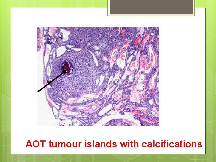 AOT tumour islands with calcifications 