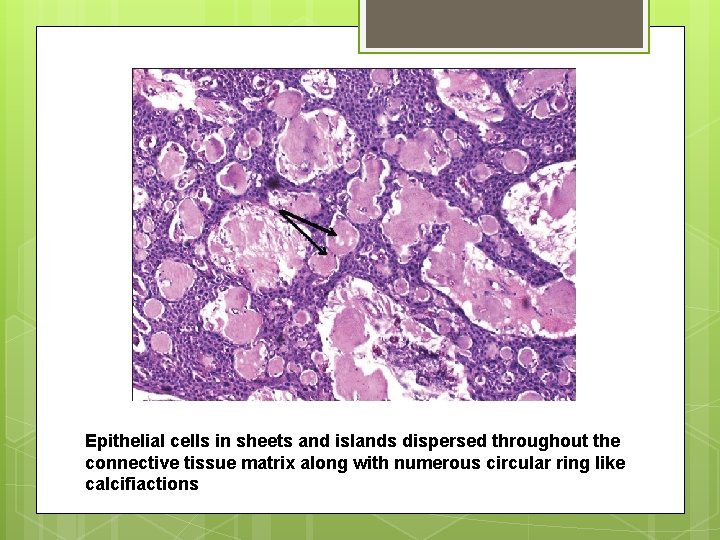 Epithelial cells in sheets and islands dispersed throughout the connective tissue matrix along with