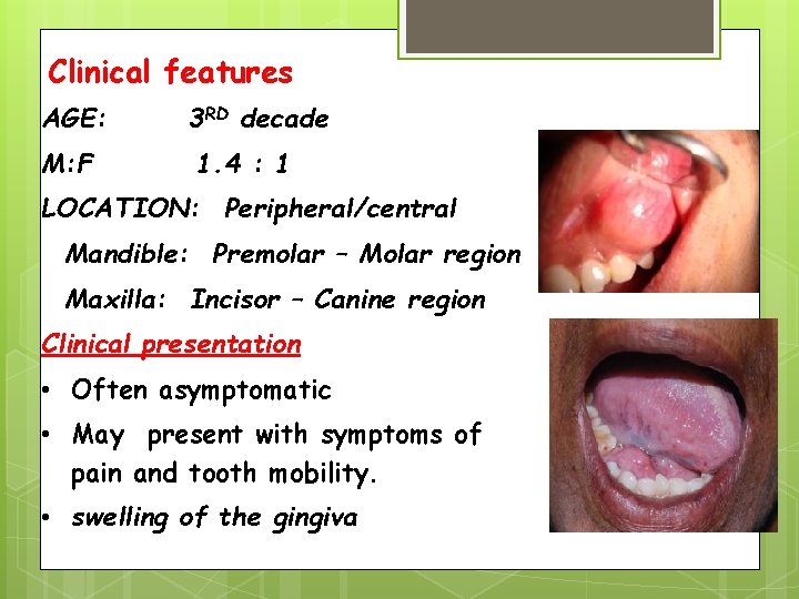 Clinical features AGE: M: F 3 RD decade 1. 4 : 1 LOCATION: Peripheral/central