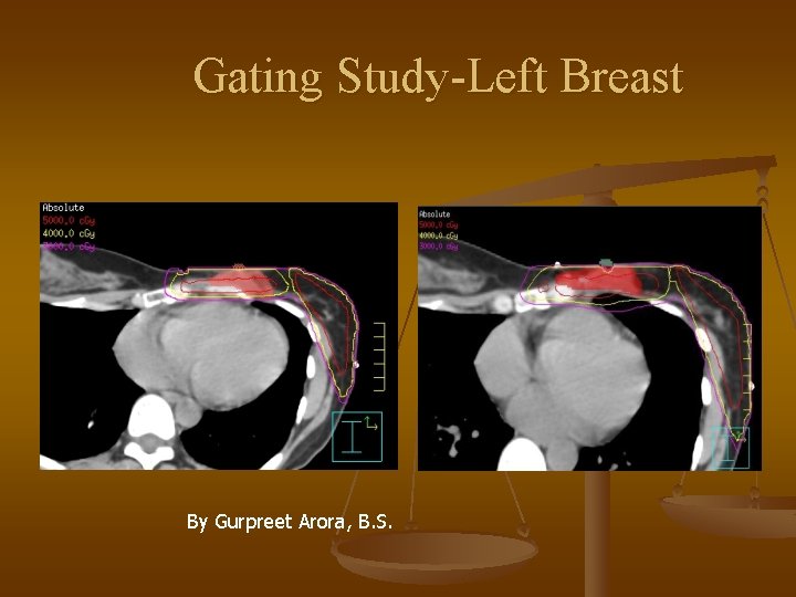 Gating Study-Left Breast By Gurpreet Arora, B. S. 