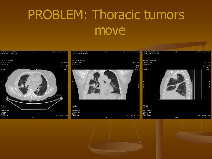 PROBLEM: Thoracic tumors move 