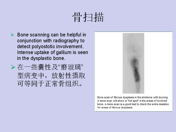 骨扫描 Ø Bone scanning can be helpful in conjunction with radiography to detect polyostotic