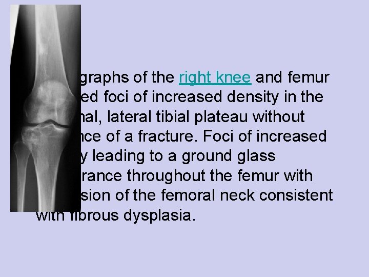  • Radiographs of the right knee and femur revealed foci of increased density