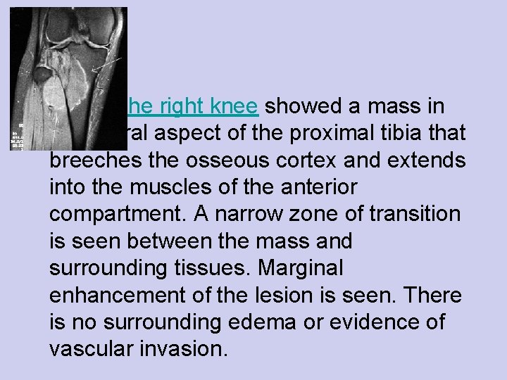  • MRI of the right knee showed a mass in the lateral aspect