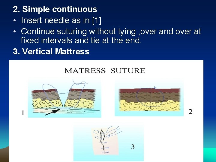 2. Simple continuous • Insert needle as in [1] • Continue suturing without tying