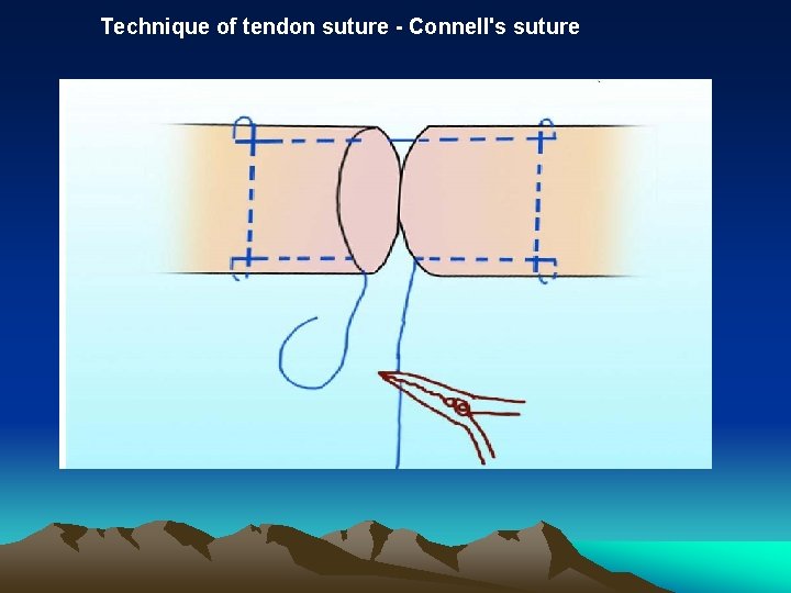 Technique of tendon suture - Connell's suture 