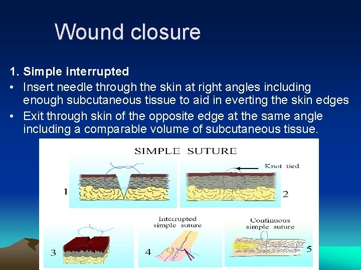Wound closure 1. Simple interrupted • Insert needle through the skin at right angles