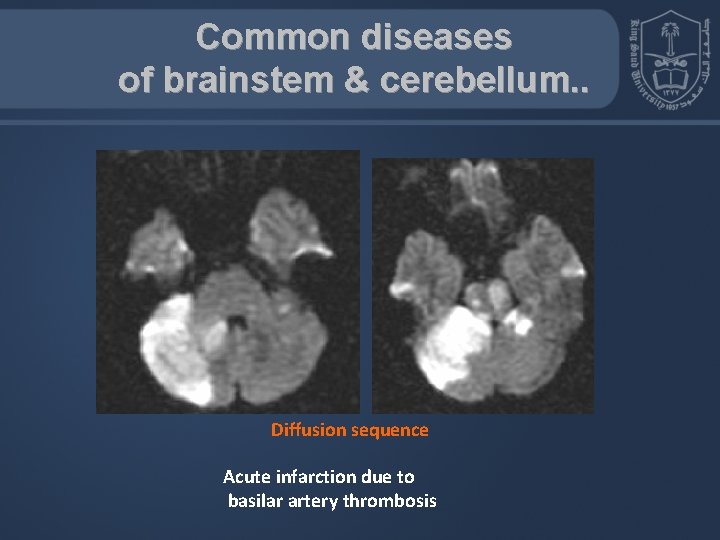 Common diseases of brainstem & cerebellum. . Diffusion sequence Acute infarction due to basilar