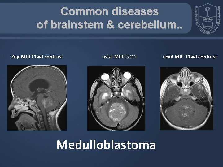 Common diseases of brainstem & cerebellum. . Sag MRI T 1 WI contrast axial