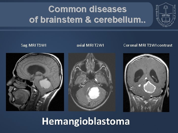 Common diseases of brainstem & cerebellum. . Sag MRI T 1 WI axial MRI