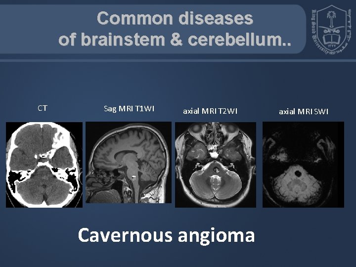 Common diseases of brainstem & cerebellum. . CT Sag MRI T 1 WI axial
