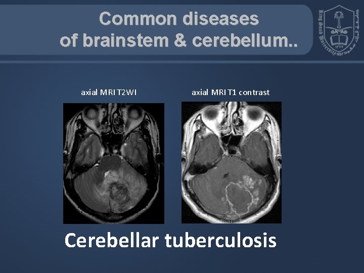 Common diseases of brainstem & cerebellum. . axial MRI T 2 WI axial MRI