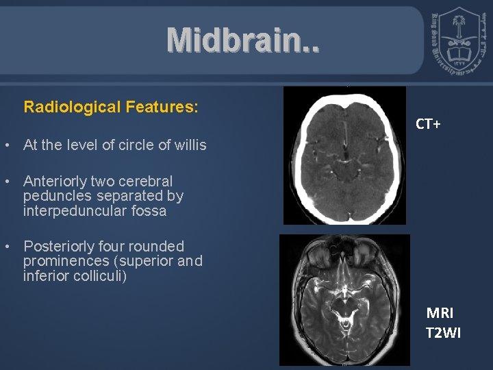 Midbrain. . Radiological Features: CT+ • At the level of circle of willis •