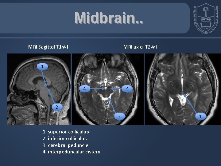 Midbrain. . MRI Sagittal T 1 WI MRI axial T 2 WI 1 4