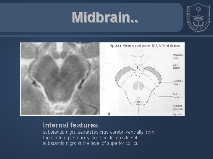 Midbrain. . Internal features: substantia nigra separates crus cerebri ventrally from tegmentum posteriorly. Red