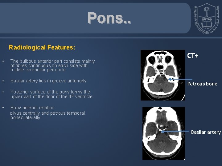 Pons. . Radiological Features: • The bulbous anterior part consists mainly of fibres continuous