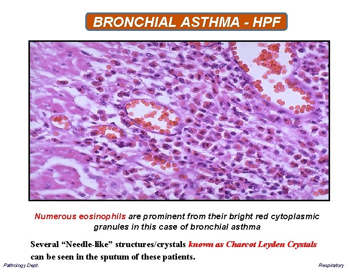 BRONCHIAL ASTHMA - HPF Numerous eosinophils are prominent from their bright red cytoplasmic granules