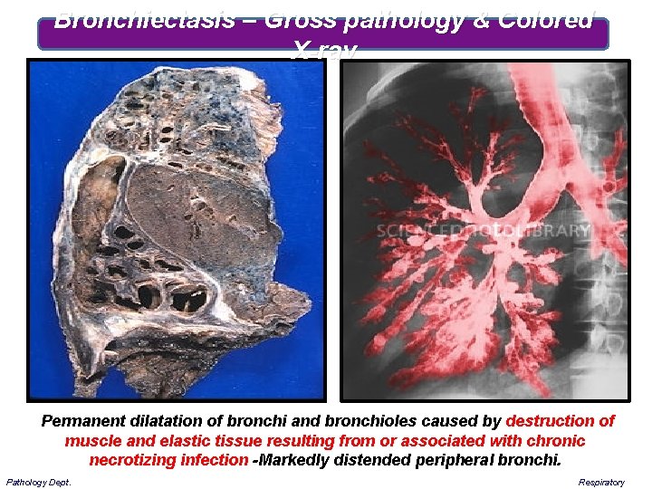 Bronchiectasis – Gross pathology & Colored X-ray Permanent dilatation of bronchi and bronchioles caused