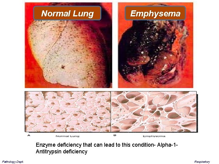 Normal Lung Emphysema Enzyme deficiency that can lead to this condition- Alpha-1 Antitrypsin deficiency