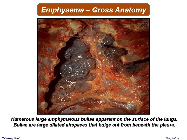Emphysema – Gross Anatomy Numerous large emphymatous bullae apparent on the surface of the