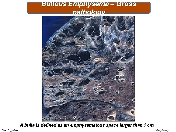 Bullous Emphysema – Gross pathology A bulla is defined as an emphysematous space larger