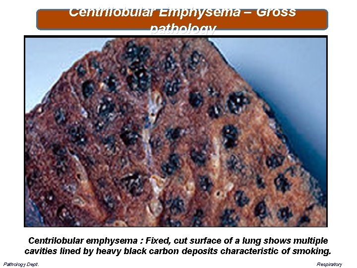 Centrilobular Emphysema – Gross pathology Centrilobular emphysema : Fixed, cut surface of a lung