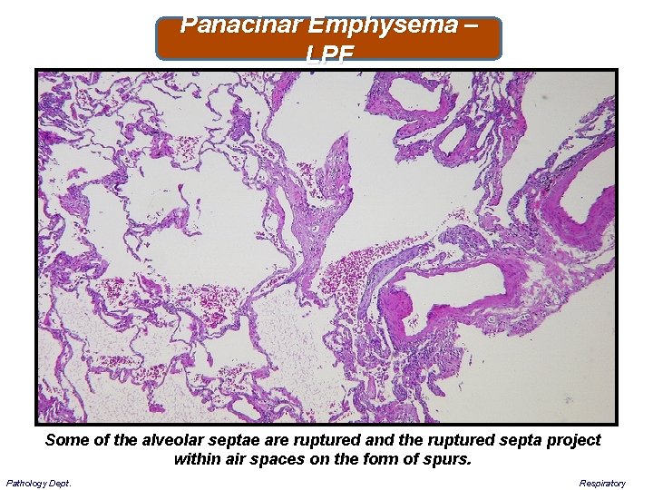 Panacinar Emphysema – LPF Some of the alveolar septae are ruptured and the ruptured