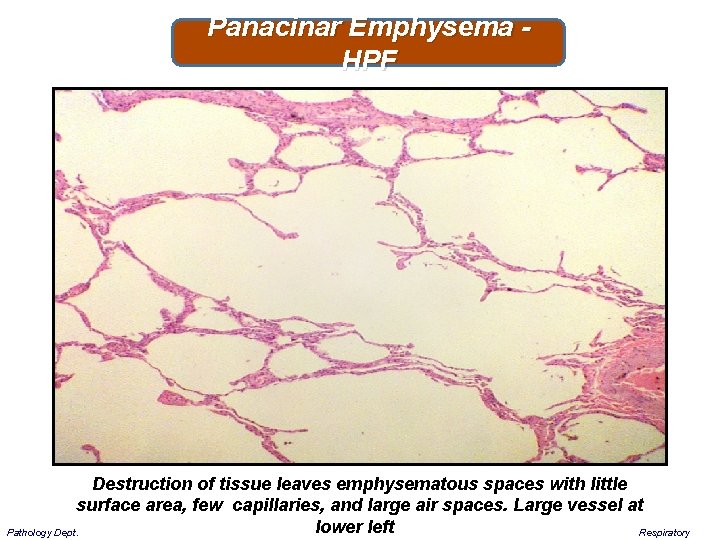 Panacinar Emphysema - HPF Destruction of tissue leaves emphysematous spaces with little surface area,