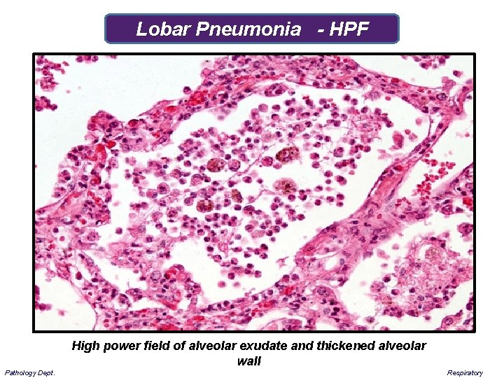 Lobar Pneumonia - HPF High power field of alveolar exudate and thickened alveolar wall
