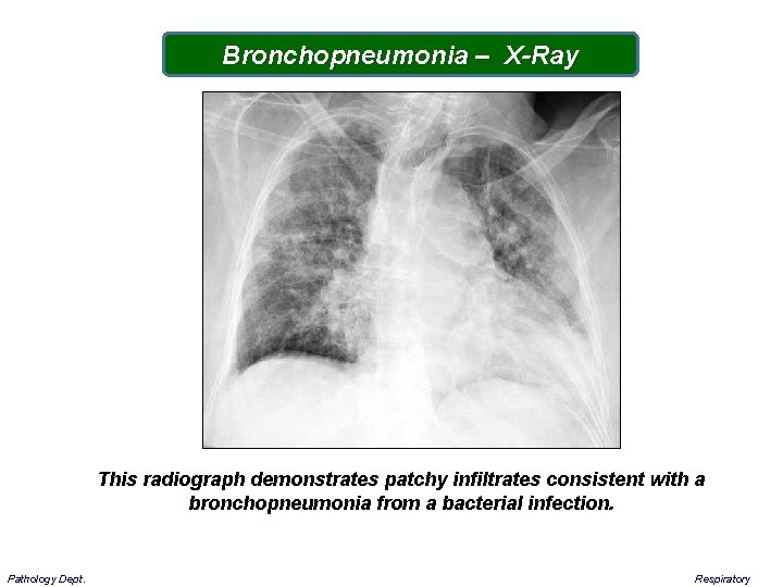 Bronchopneumonia – X-Ray This radiograph demonstrates patchy infiltrates consistent with a bronchopneumonia from a