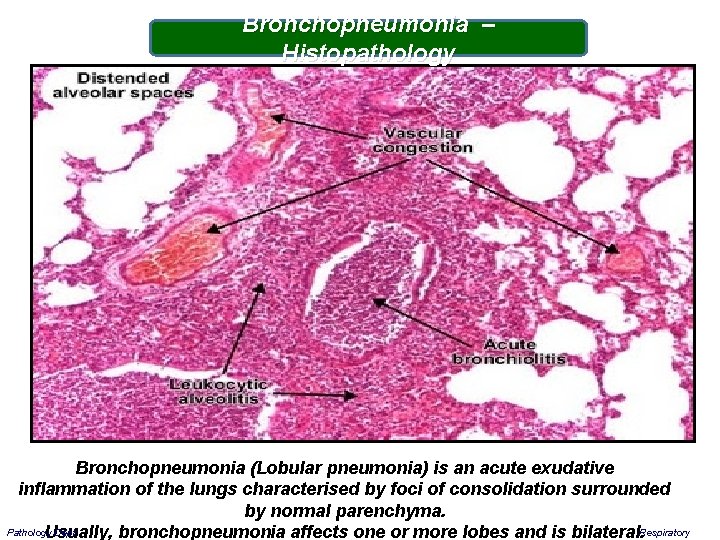 Bronchopneumonia – Histopathology Bronchopneumonia (Lobular pneumonia) is an acute exudative inflammation of the lungs