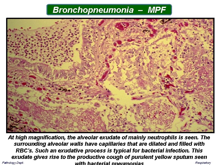 Bronchopneumonia – MPF At high magnification, the alveolar exudate of mainly neutrophils is seen.