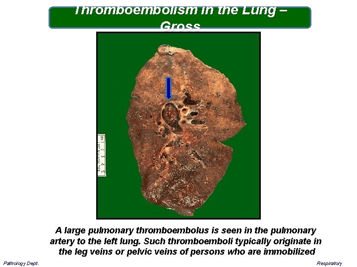 Thromboembolism in the Lung – Gross A large pulmonary thromboembolus is seen in the