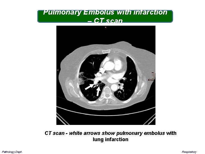 Pulmonary Embolus with infarction – CT scan - white arrows show pulmonary embolus with