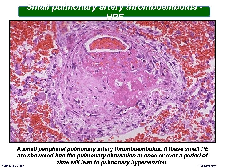 Small pulmonary artery thromboembolus - HPF A small peripheral pulmonary artery thromboembolus. If these