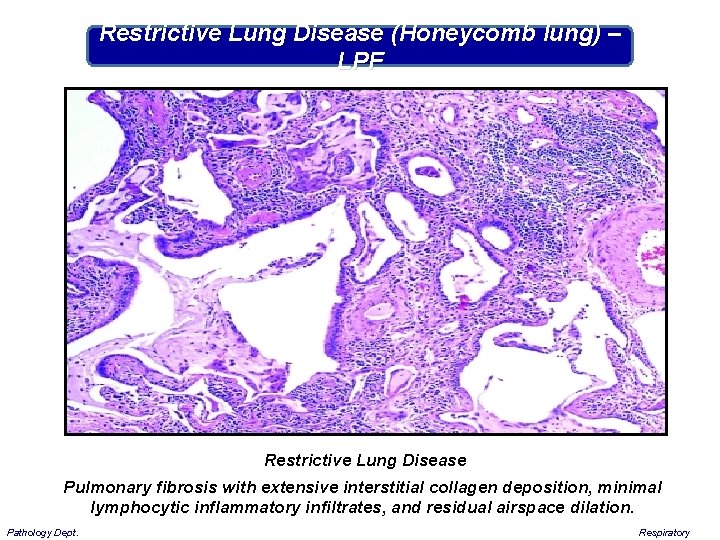 Restrictive Lung Disease (Honeycomb lung) – LPF Restrictive Lung Disease Pulmonary fibrosis with extensive
