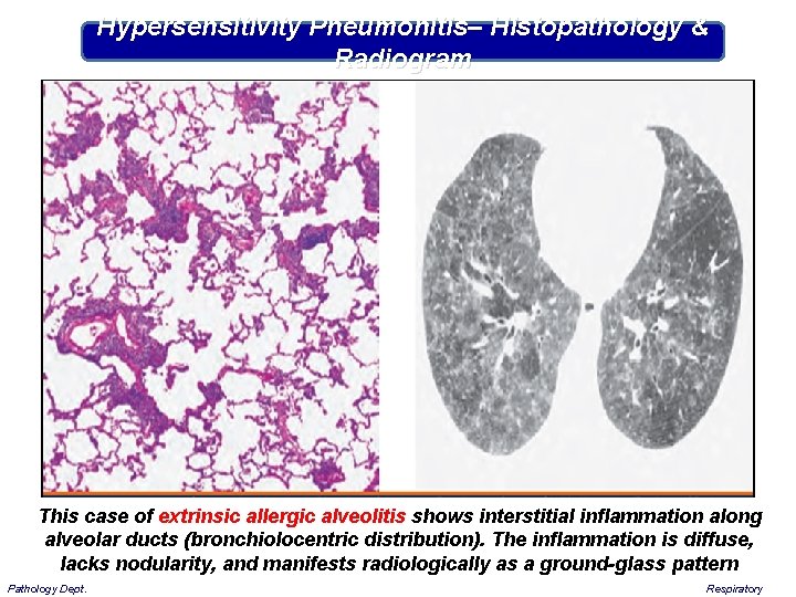 Hypersensitivity Pneumonitis– Histopathology & Radiogram This case of extrinsic allergic alveolitis shows interstitial inflammation