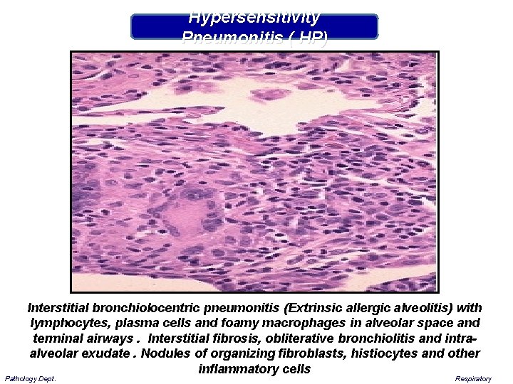 Hypersensitivity Pneumonitis ( HP) Interstitial bronchiolocentric pneumonitis (Extrinsic allergic alveolitis) with lymphocytes, plasma cells
