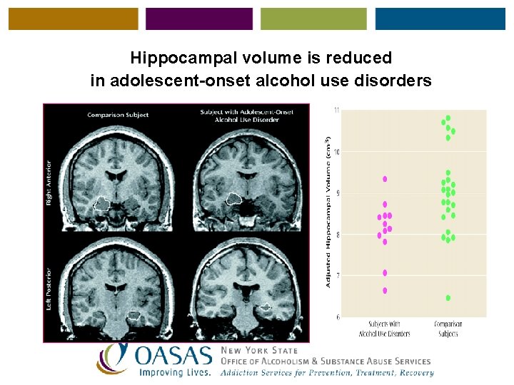 Hippocampal volume is reduced in adolescent-onset alcohol use disorders 