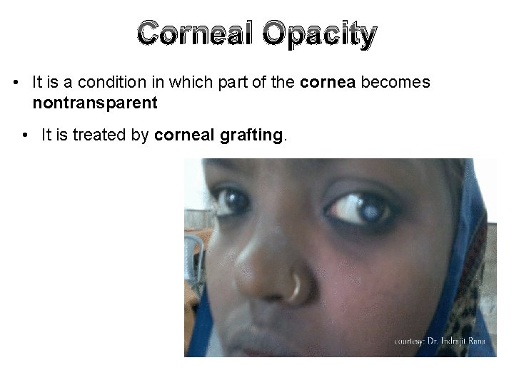 Corneal Opacity • It is a condition in which part of the cornea becomes