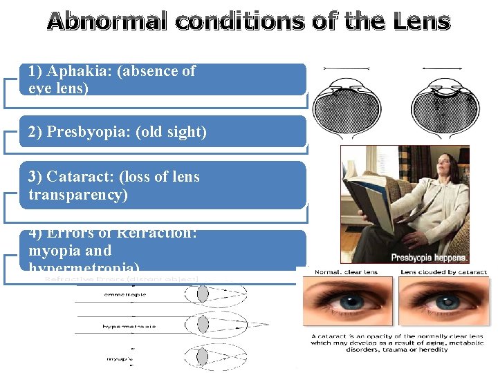 Abnormal conditions of the Lens 1) Aphakia: (absence of eye lens) 2) Presbyopia: (old