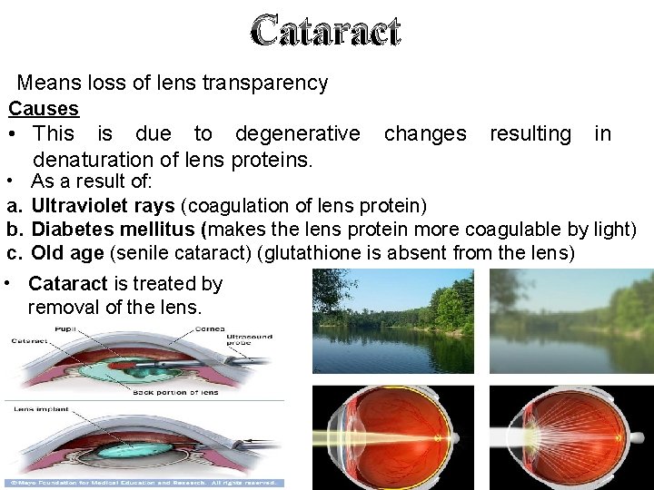 Cataract Means loss of lens transparency Causes • This is due to degenerative denaturation