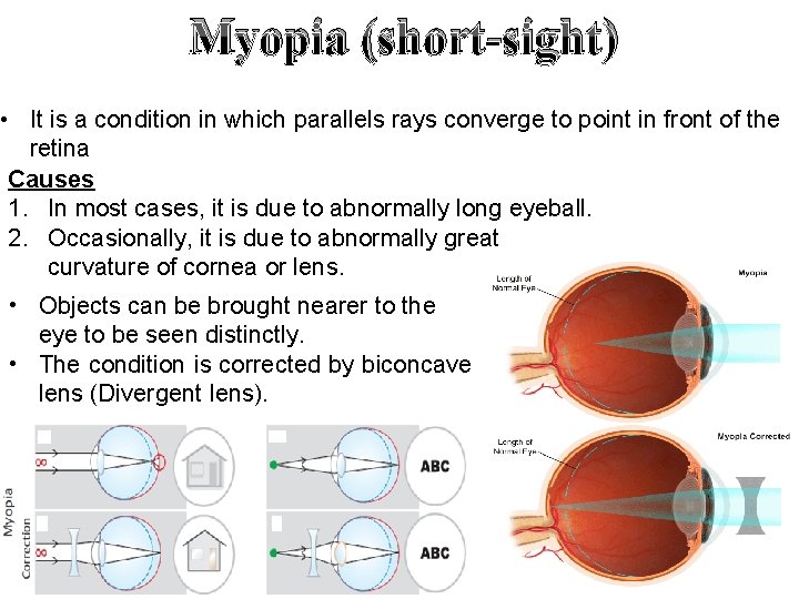 Myopia (short-sight) • It is a condition in which parallels rays converge to point