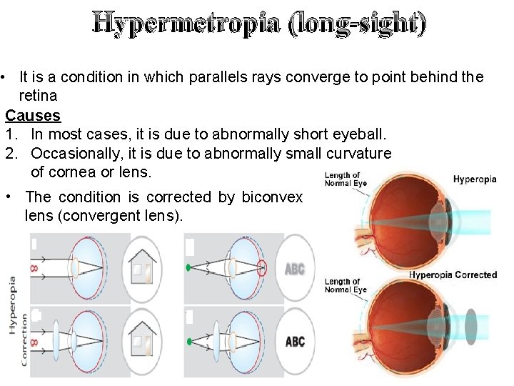 Hypermetropia (long-sight) • It is a condition in which parallels rays converge to point