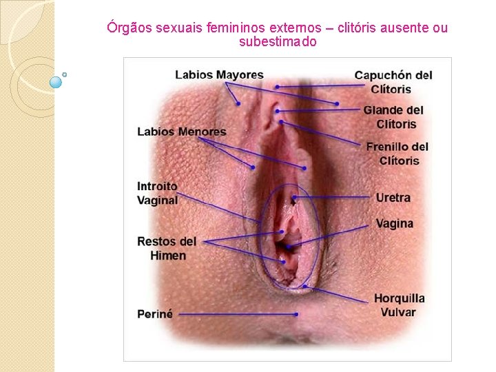 Órgãos sexuais femininos externos – clitóris ausente ou subestimado 